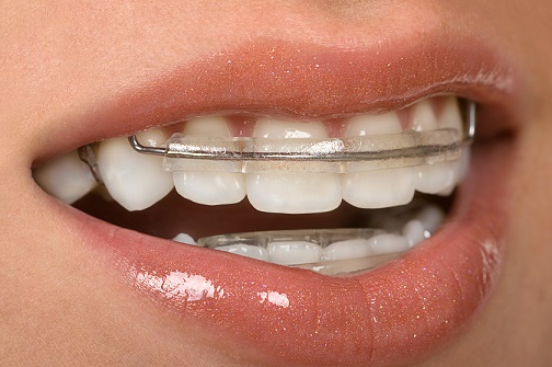 A female mouth with dental braces attached to teeth.