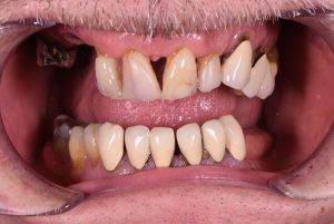 Teeth before dental implants