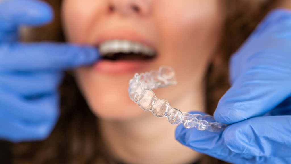 Dentist wearing blue gloves holding onto a clear aligner to place into the patient's mouth.
