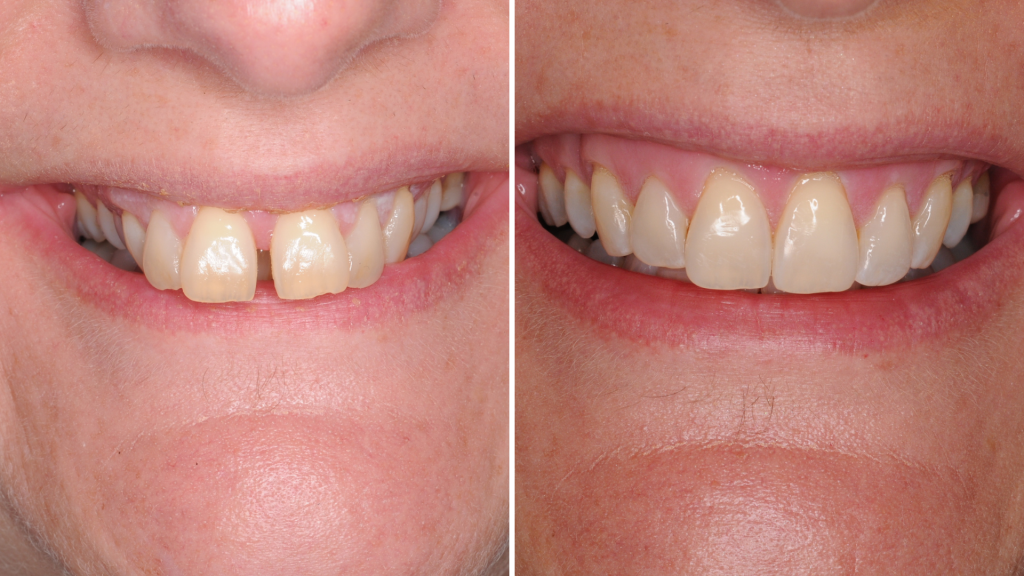 A before and after of patient, Sarah's, orthodontic treatment.